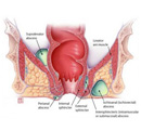 Precautions before treatment of perianorectal abscess?